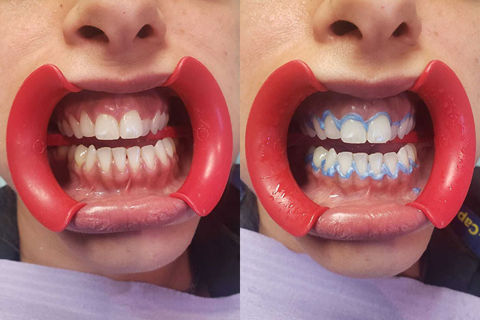 Antes y despues dentadura blanqueada