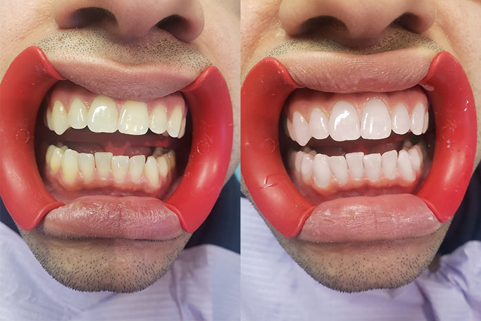 Antes y despues dentadura blanqueada